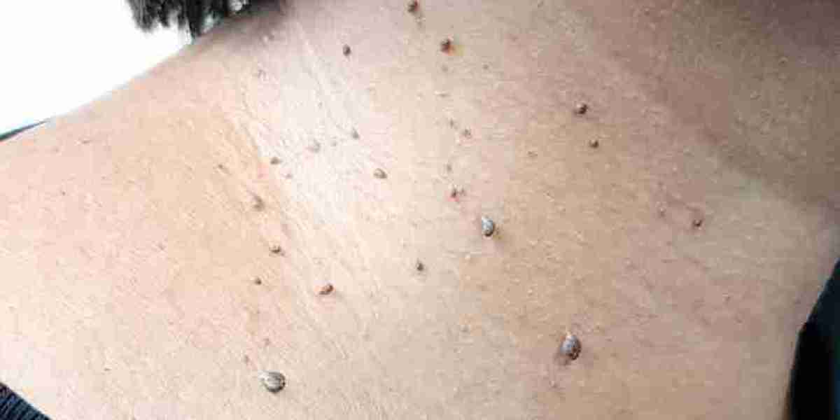 Skin Tag Removal in London: How Are Skin Tags Assessed Before Removal?