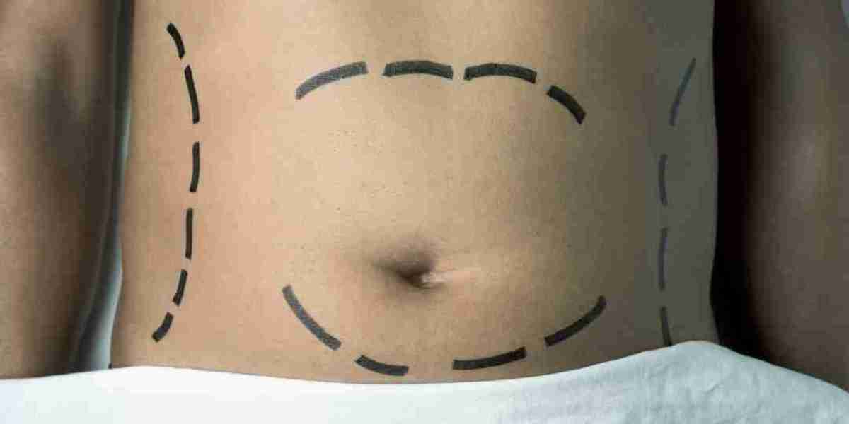Does Liposuction Give Long-Lasting Results for Body Confidence Boost?