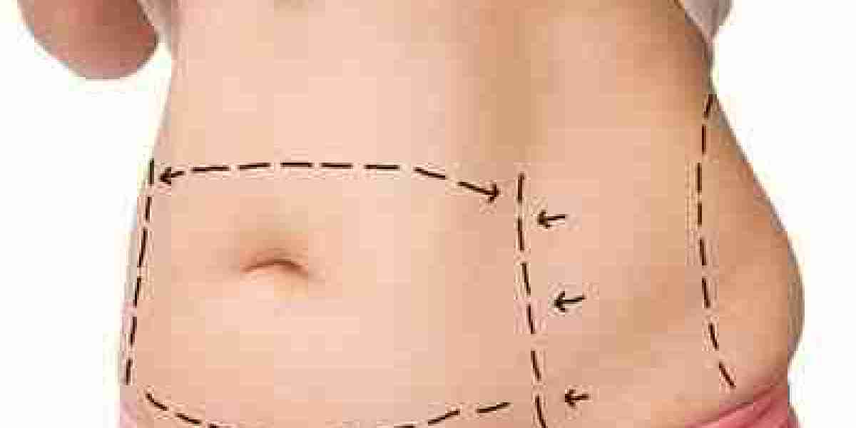 What Should You Look for When Choosing a Tummy Tuck Clinic in Dubai?