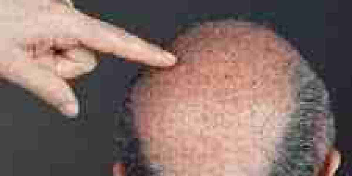 How Does a Hair Transplant Clinic Assess Your Donor Hair?