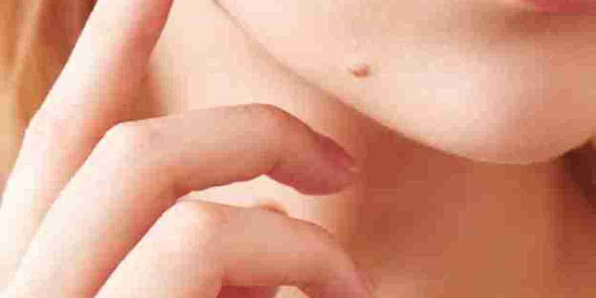 Mole Removal in Dubai: What Patients Ask Most Often