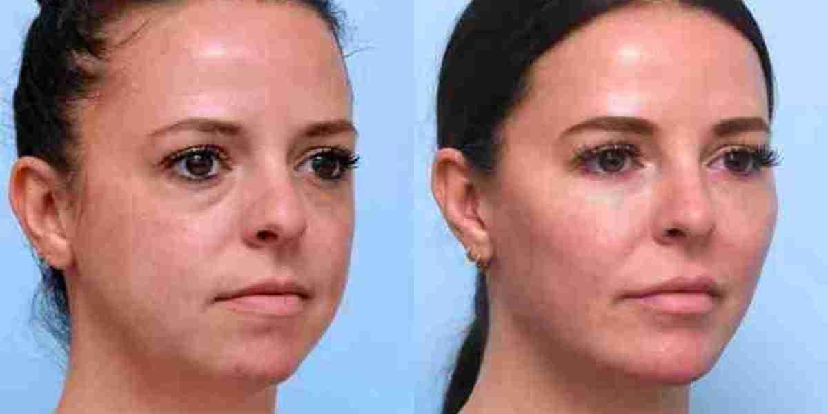Best Plastic Surgeon in Dubai: Thread Lift for Youthful Skin