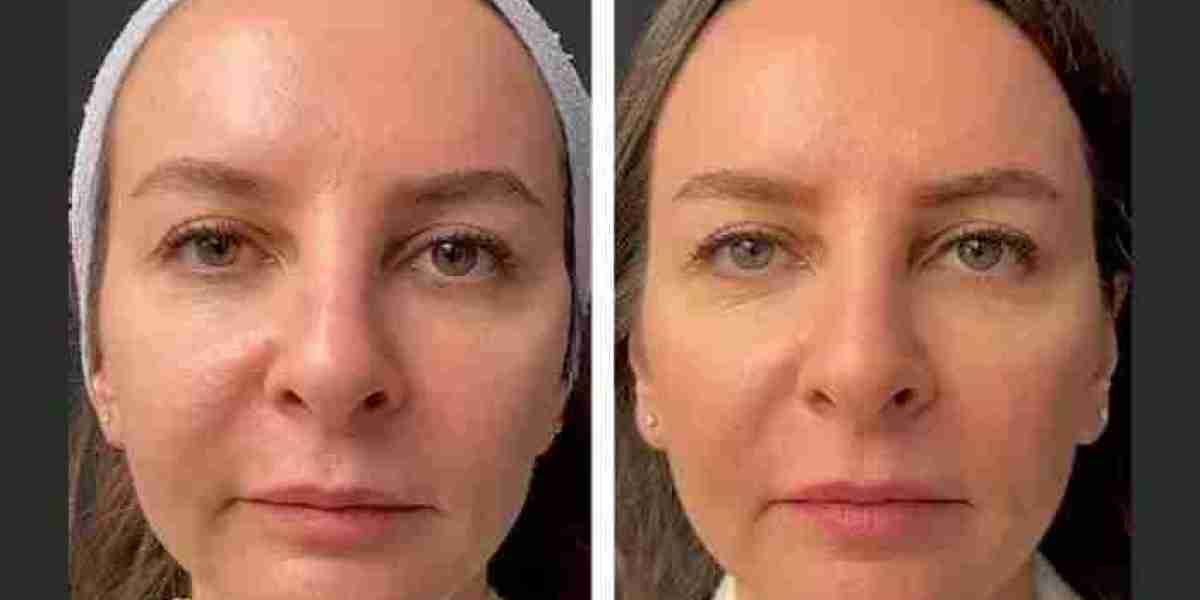 Mesotherapy Treatments in Dubai for Hair Growth