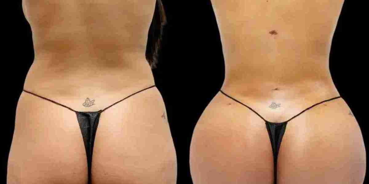 Fat Transfer Surgery in Dubai: Why Stable Weight Matters After Surgery