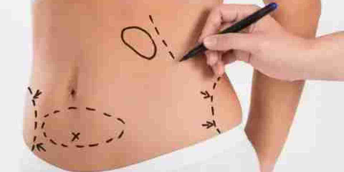 Mini Tummy Tuck in Dubai: Preparing for Your Procedure