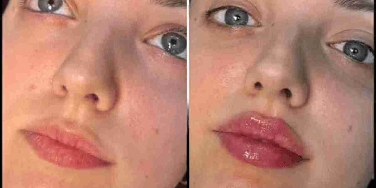 Fillers Treatment in Dubai: And Natural Enhancements