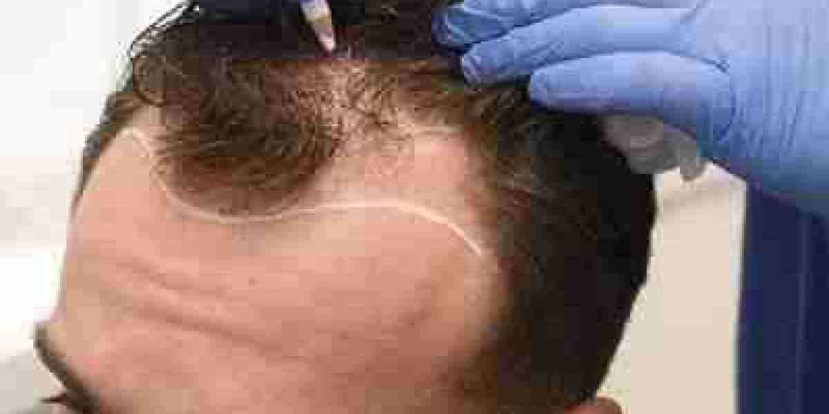 Hair Loss Treatment Clinic in Dubai: Supporting Hair Restoration