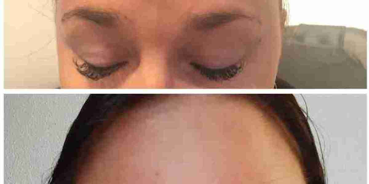 Over 30 and Noticing Forehead Lines? Why Preventative Botox Is Getting More Attention in 2026