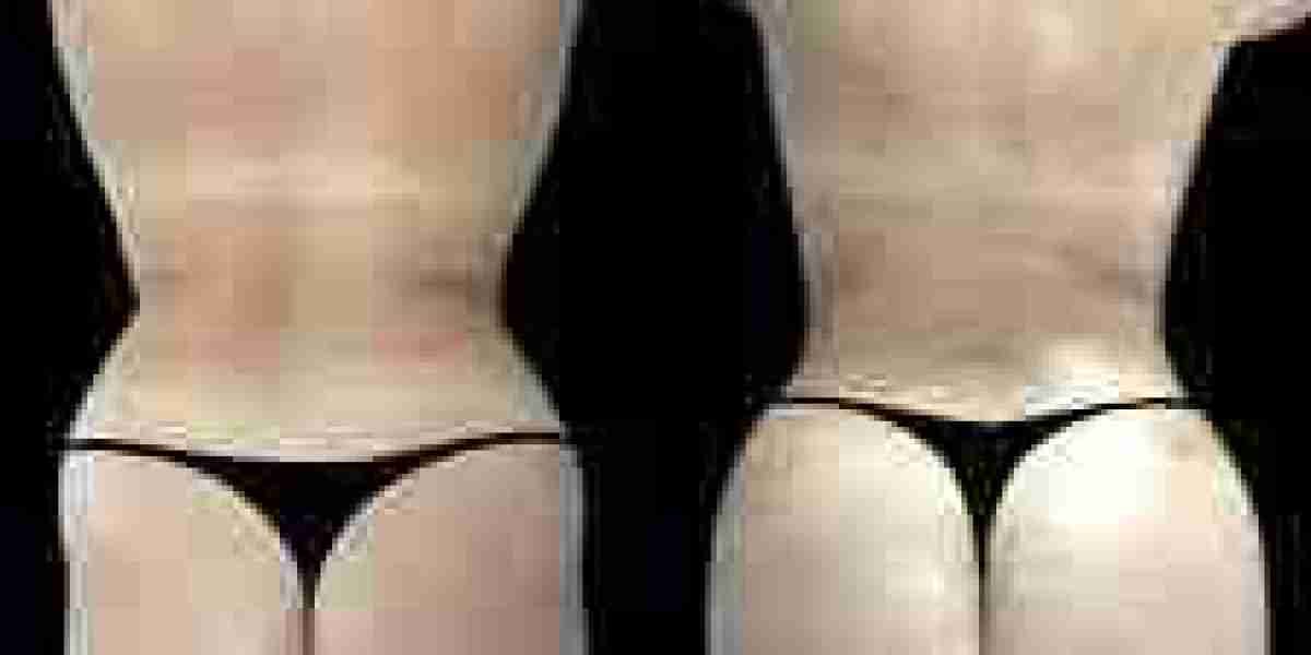 Butt Fat transfer surgery in dubai: A Complete Guide for International Patients