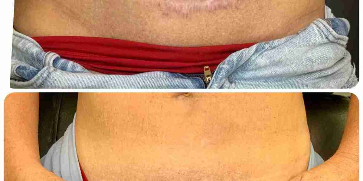 How to Find the Right Scar Camouflage Treatment for Your Needs