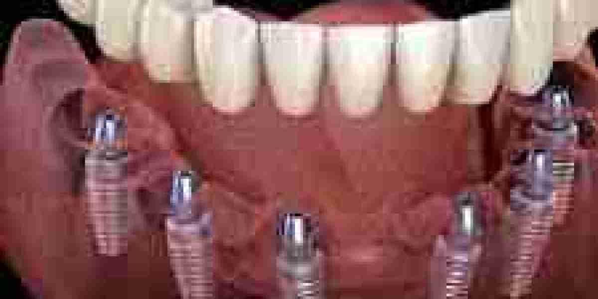 How Long Do Dental Implants Last? Benefits, Care and Maintenance